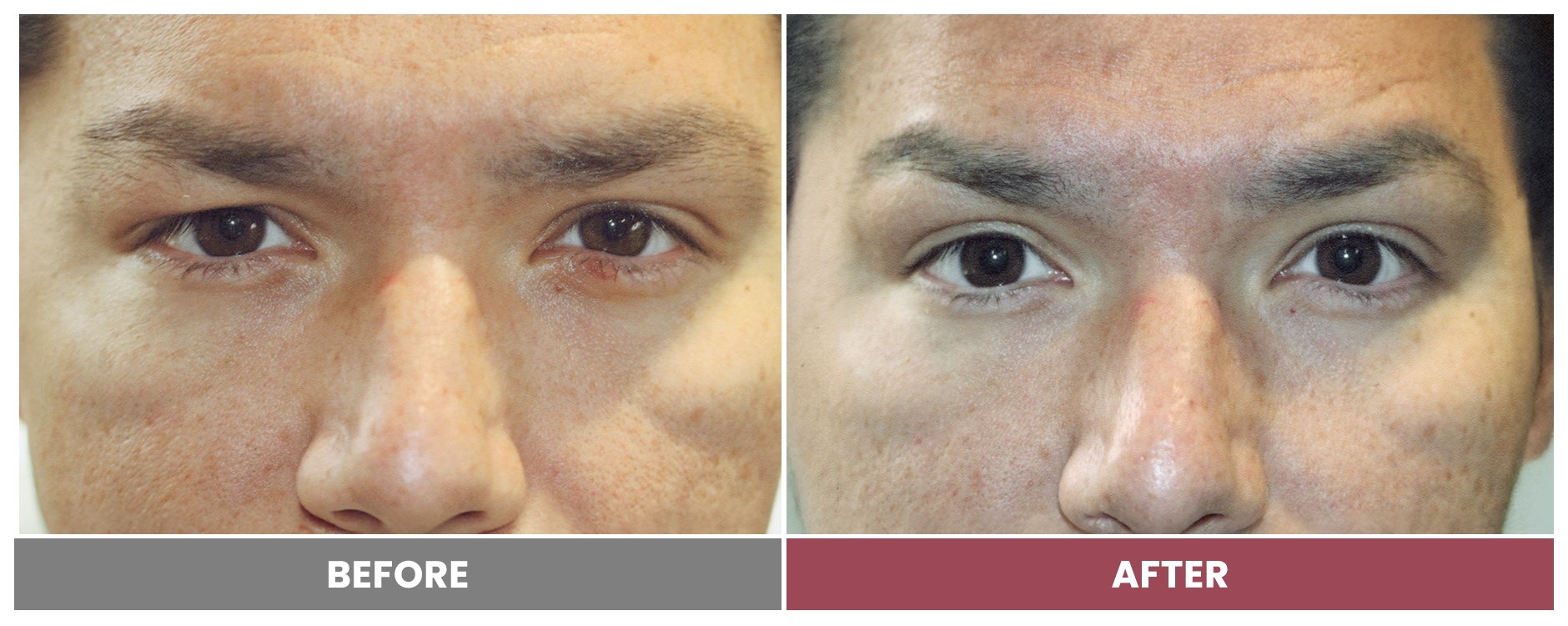 Upper Blepharoplasty - Case 52